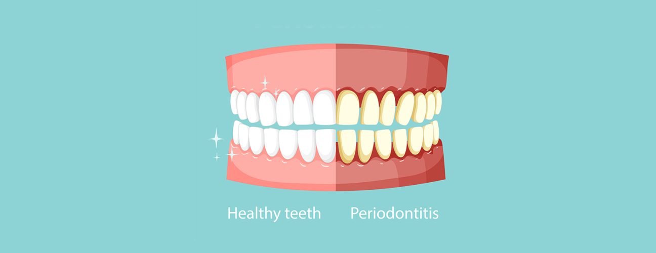 What Are Gum Line Cavities? Causes, Signs, and How to Treat Them