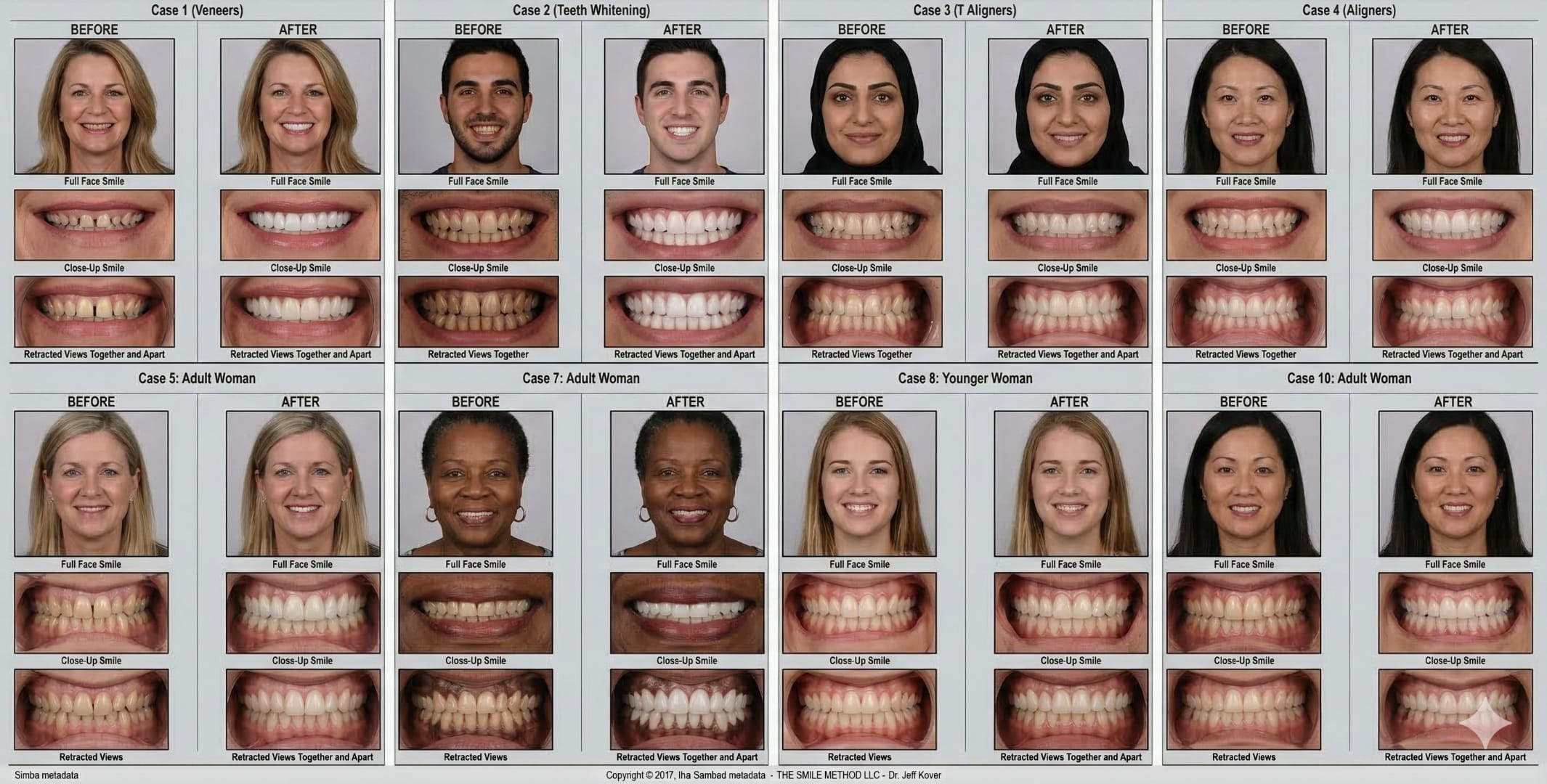 Before and after smile transformations at The Smile Method - cosmetic dentistry cases including veneers, teeth whitening, and aligners by Dr. Jeff Kover in Columbus and Gahanna Ohio